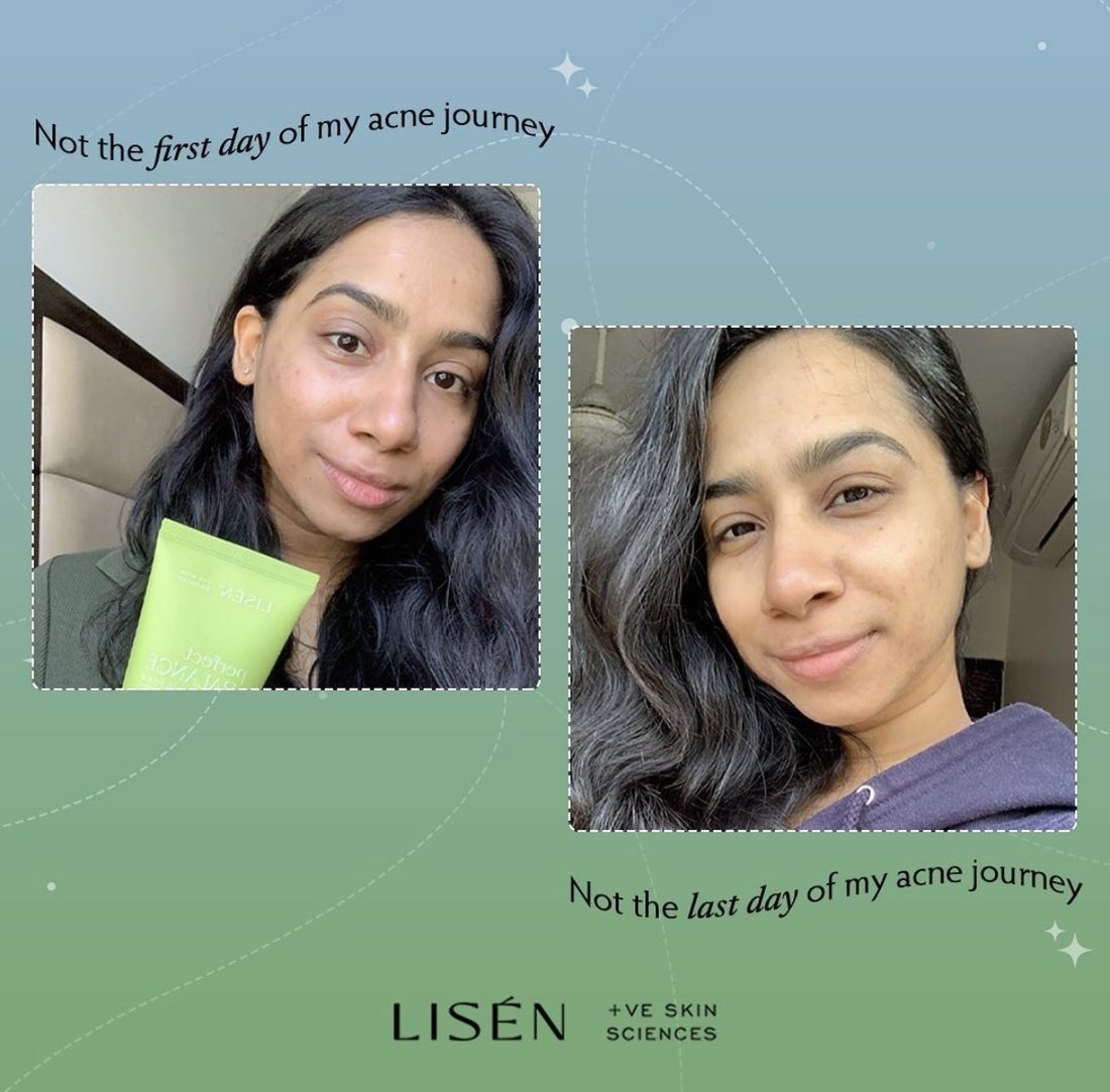 Ally to My Acne 5